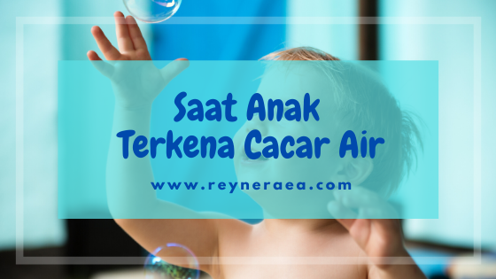 mengatasi cacar air pada anak