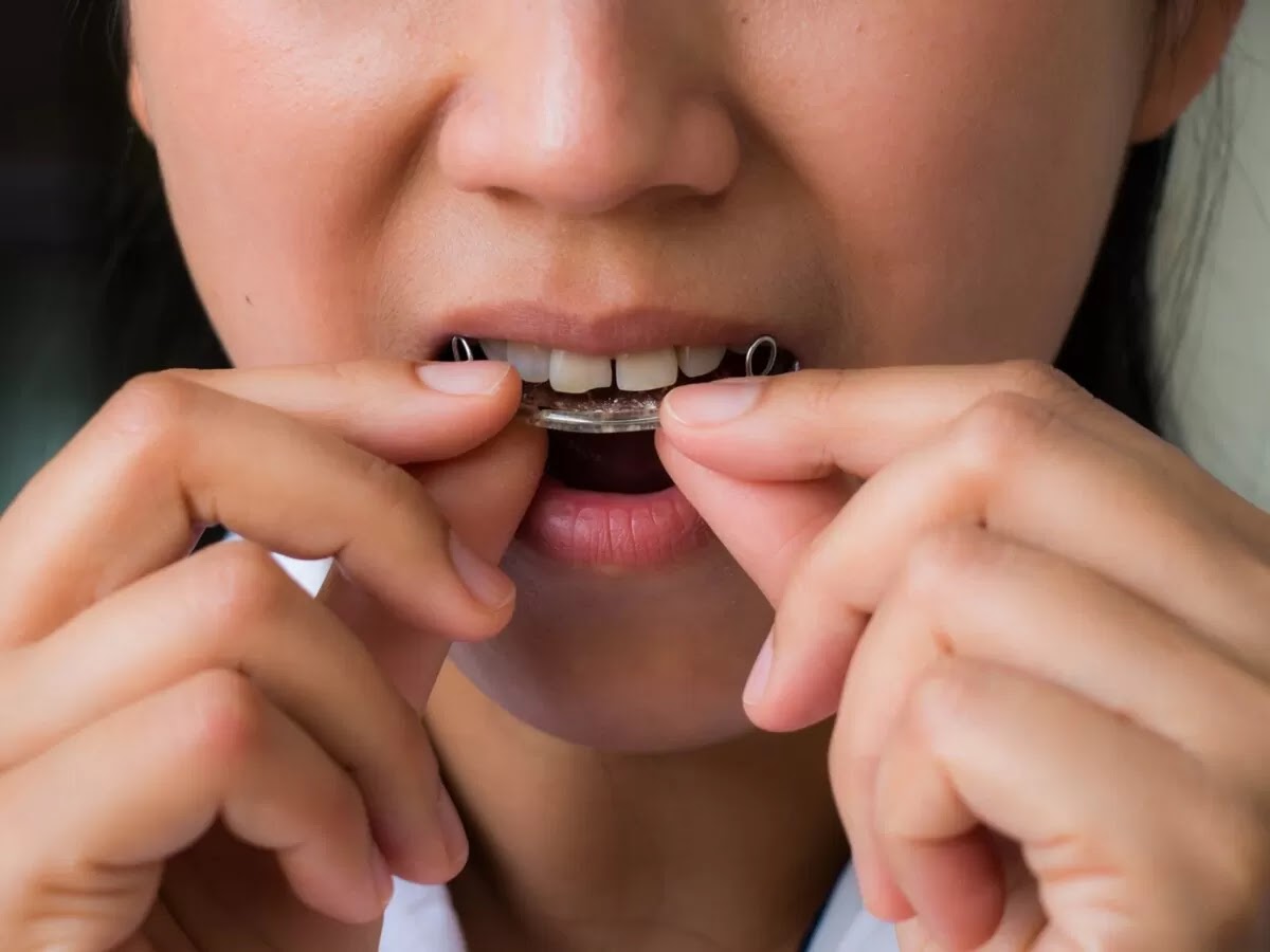 Can You Have Braces With False Teeth?