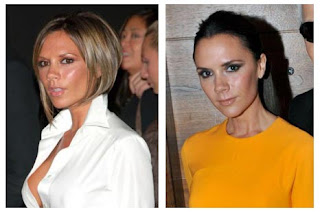 Victoria Beckham Breast Implants Removal