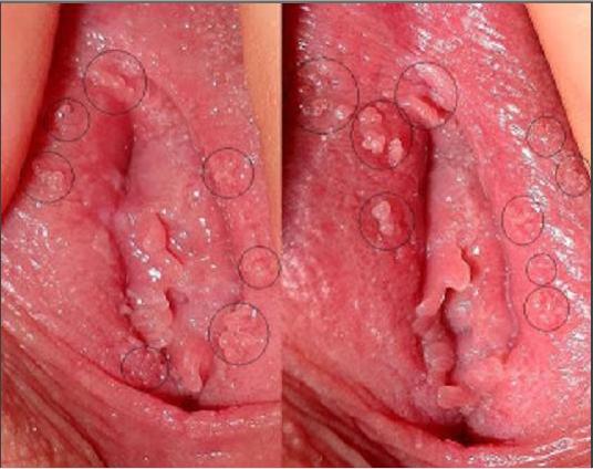 Cara Menyembuhkan Virus Hpv