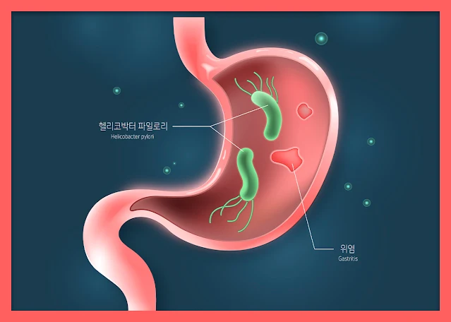 위염