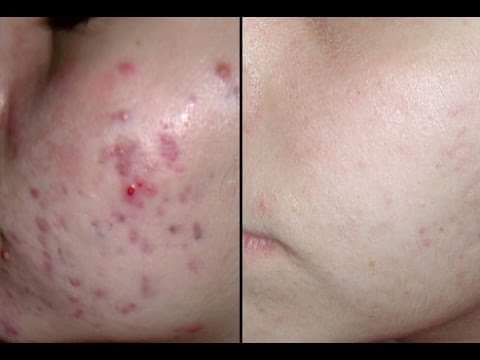 Some recipes for acne and its effects