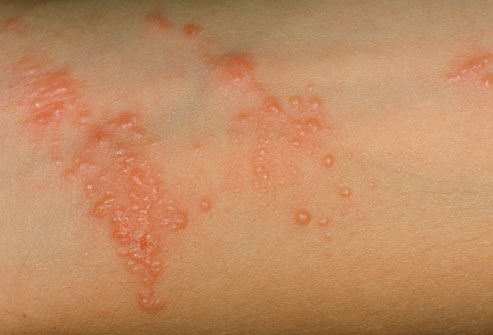 pictures of poison sumac rash. poison sumac rash images.