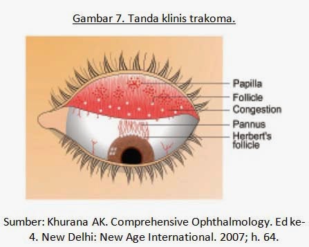Obat Herbal Penyakit Mata  Trakoma Trachoma Blog 