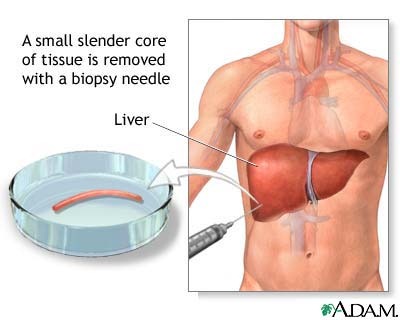 liver-biopsy