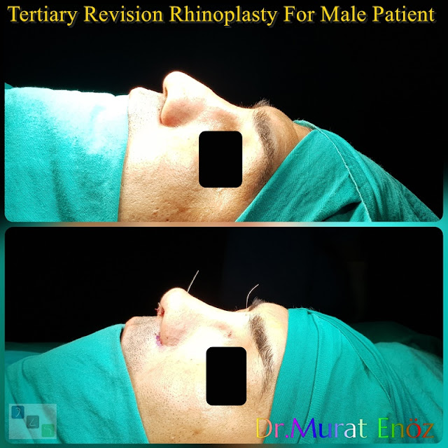 Tertiary Revision Rhinoplasty For Male Patient - Alar Base Resection - 3rd Revision Nose Job With Cadaveric Rib Cartilage - Revision Nose Aesthetic Doctor in Istanbul