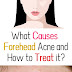 What causes forehead acne and how to Treat it?