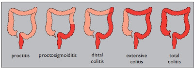 types of ulcerative colitis