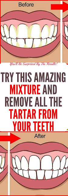 Try This Amazing Mixture And Remove All the Tartar From Your Teeth!