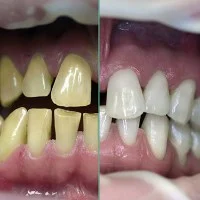 Untung Rugi Kesehatan dari Memutihkan Gigi