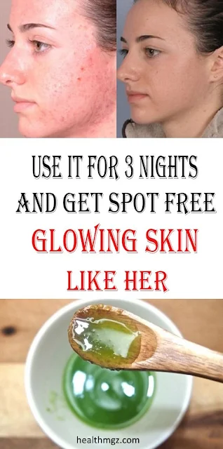 Use This For Few Nights, And Get Spot Free Glowing Skin