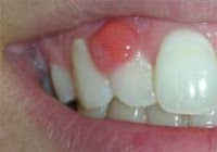 Infection in gums home remedy