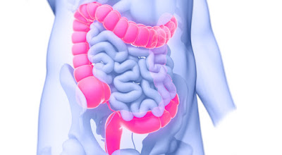 diverticulosis : causes, symptoms, treatment and prevention