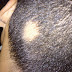 Penyebab Alopecia Areata