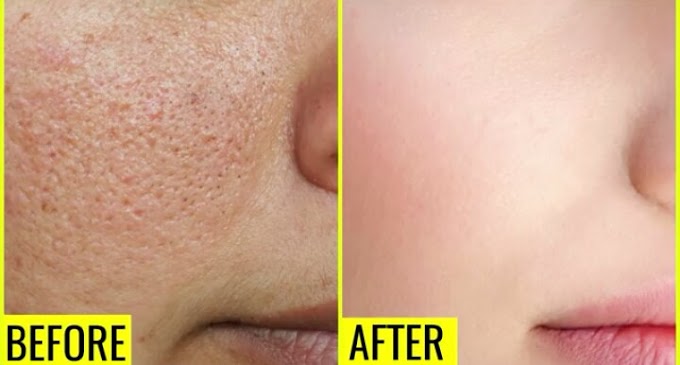 How To Get Crystal Clear Skin At home | Glowing, Spotless Skin |  Remove Acne & Pimple Scars | Reduce Pores