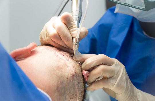 Il chirurgo che estrae dei follicoli a un paziente con micro motore