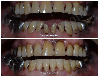 Zirconia Crown and Composite for Attrited Teeth