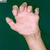 Lesión de nervio cubital o mano en garra. Causas, tratamiento de fisioterapia
