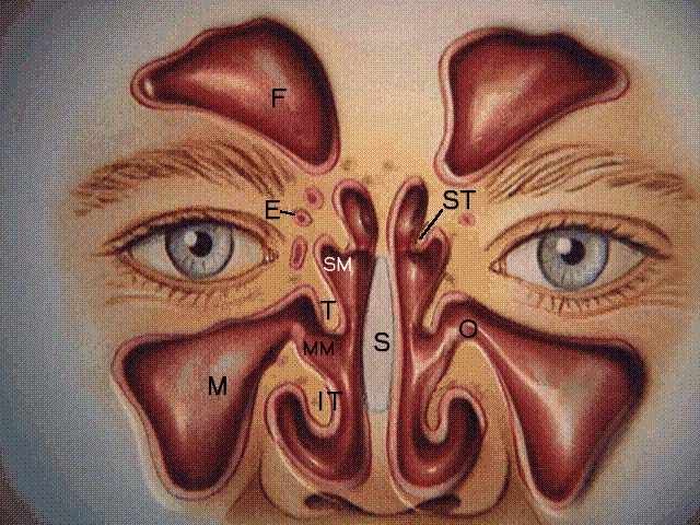 sinusitis maksilaris