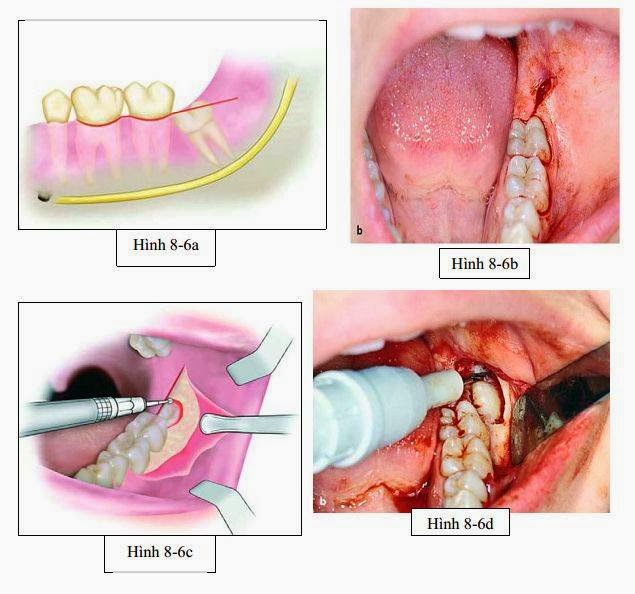 nhổ răng khôn mọc nghiêng