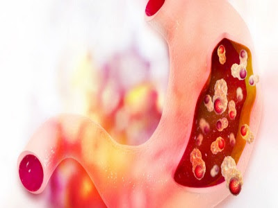 Gastric Cancer Therapeutics Market - TechSci Research