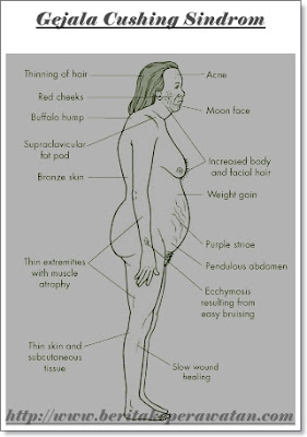 Penyakit Apakah Cushing Sindrome ?