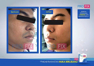 Review Ubat Muka Berlubang Paling Berkesan,Pantas Dan 