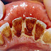 Cao răng huyết thanh là gì? Có hại không?