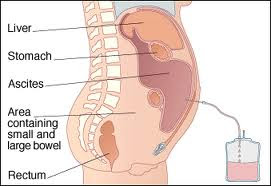 Peritoneal Mesothelioma