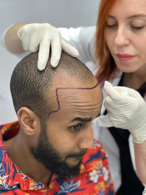 Heva Clinic: Afro-Hair Transplant Specialization in Turkey