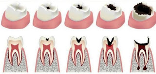 كيف يحدث تسوس الاسنان