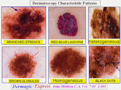 Patterns of lesions seen with the dermatoscope