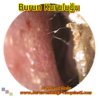 Burun etlerini büyümek zorunda bırakmayın! - Burun eti ameliyatı sonrasında, burun etleri neden yeniden  büyüyebilir? - Burun eti küçültülmesi için en ideal yöntem hangisidir? -  Lazerle burun eti ameliyatı mümkün müdür? - Burun etlerinin büyümemesi için önlemler