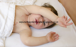 bintik merah pada kulit bayi