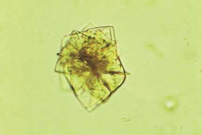 Uric acid crystals in rosette formation