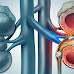 Kidney stones | Know your disease | Askurdoctor.net