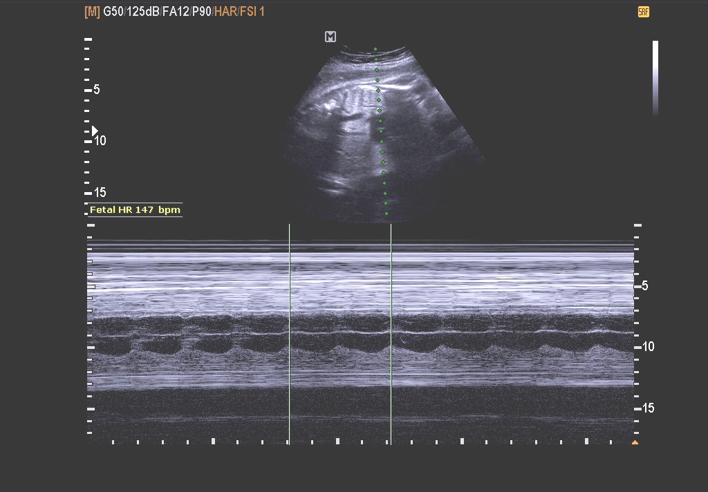 BILIK SONOGRAFER : USG Trimester 2/3