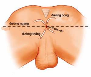 TRIỆU CHỨNG VÀ CÁCH ĐIỀU TRỊ RÒ HẬU MÔN