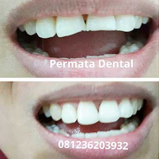 gambar foto gigi patah sebelum dan sesudah dilakukan veneer