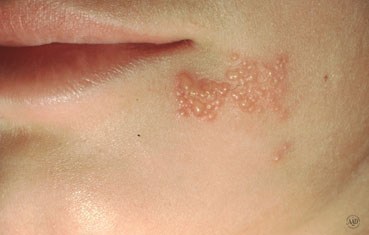 cara menghilangkan herpes