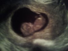 Baby's first picture at 10 weeks