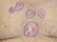 skin cancer examples