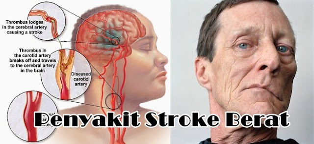 ICP Capsule obat stroke berat terbukti ampuh