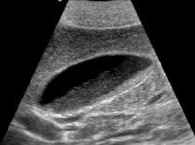 MRI kolelitiasis dengan biliary sludge di kantong empedu., pemeriksaan penunjang, rumah sakit, puskesmas, pencitraan, imaging, lumpur empedu, biliary sludge, batu kolesterol, batu pigmen, magnetic resonance imaging