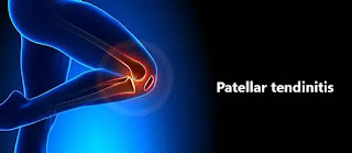 Patellar tendinitis