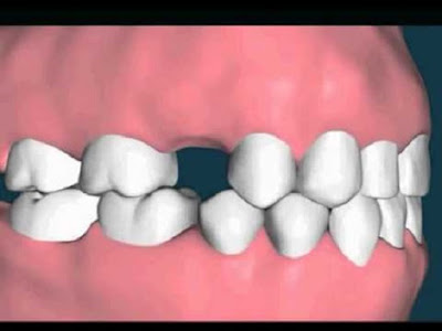 Răng hàm mất gây ra tác hại gì?