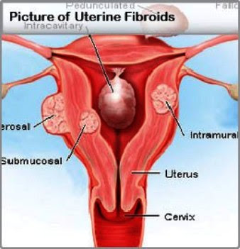 Fibroids: What Every Woman Should Know