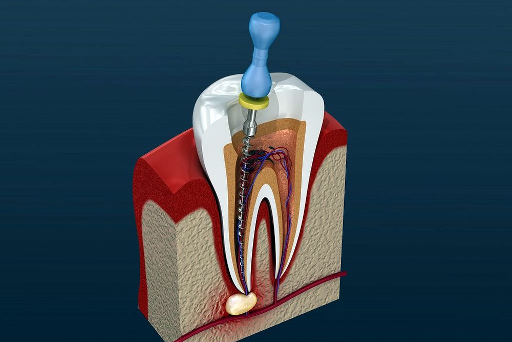 Endodontic