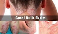 Pengobatan Alami Redakan Neurodermatitis