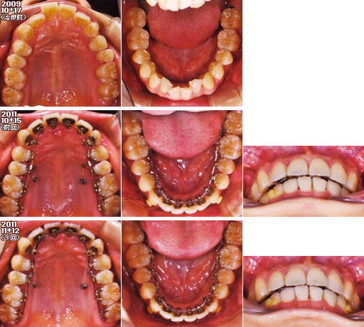 歯列矯正：定期検診その16